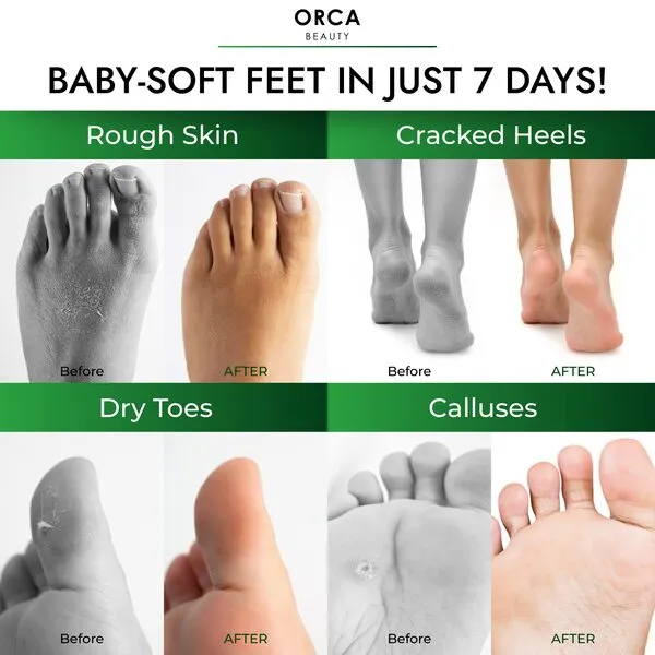 Foot Mask 8 Pairs, Foot Mask for Dry Cracked Feet - Foot Moisturizer Mask, Foot Moisturizer for Dry Cracked Feet - Foot Mask Moisturizing, Foot Spa Mask for Dry Skin - Peach & Tea Tree Scent